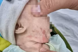 Bé trai 2 tháng tuổi loét khắp người vì mắc giang mai bẩm sinh