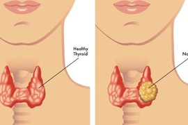 Bệnh tuyến giáp giai đoạn mạn kinh dễ bị chẩn đoán nhầm