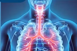 Bác sĩ mách cách phòng bệnh COPD bảo vệ lá phổi cuộc đời