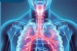 Bác sĩ mách cách phòng bệnh COPD bảo vệ lá phổi cuộc đời