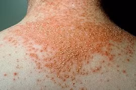 Biến chứng ghẻ có thể viêm cầu thận