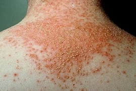 Biến chứng ghẻ có thể viêm cầu thận