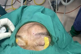 Phồng trán không ngờ u nhầy xoang trán hiếm gặp