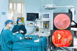 Lần đầu phẫu thuật tạo hình xương con tai giữa tại BV Nhi Thanh Hoá