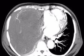 U nhỏ không điều trị để nặng 2kg choán hết lồng ngực, đè xẹp phổi....