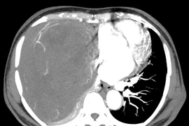 U nhỏ không điều trị để nặng 2kg choán hết lồng ngực, đè xẹp phổi....