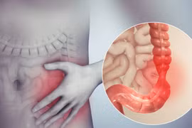Cách chữa Hội chứng ruột kích thích không khỏi và rất dễ tái lại