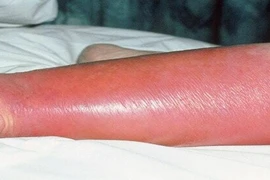 Vi khuẩn thường trực trên da gây viêm mô tế bào nguy kịch khi trầy xước