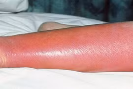 Vi khuẩn thường trực trên da gây viêm mô tế bào nguy kịch khi trầy xước