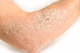 Cách phòng tránh khởi phát và tăng nặng bệnh vẩy nến