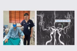 Can thiệp mạch lấy huyết khối, giải pháp tối ưu trong trị nhồi máu não cấp