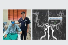 Can thiệp mạch lấy huyết khối, giải pháp tối ưu trong trị nhồi máu não cấp