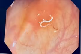 Phát hiện giun còn sống trong đại tràng của người đàn ông