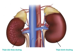 Biến chứng thận do đái tháo đường dễ tử vong
