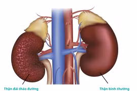 Biến chứng thận do đái tháo đường dễ tử vong