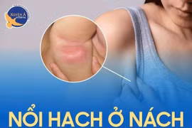 Nổi hạch ở nách khi nào cần đi khám?