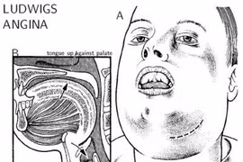 Tự chữa đau răng người đàn ông suýt tử vong vì viêm tấy sàn miệng 