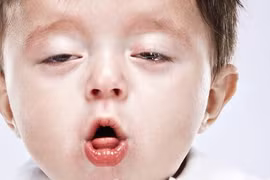 Bé trai 1 tháng tuổi viêm phổi nặng vì ho gà: Cách gì phòng tránh?