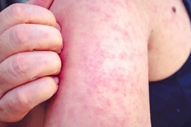 Cảnh báo bùng phát bệnh sởi: Nguyên nhân, triệu chứng và biện pháp phòng ngừa