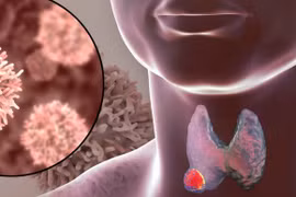 Chế độ ăn ăn kiêng cho bệnh nhân uống I - ốt phóng xạ