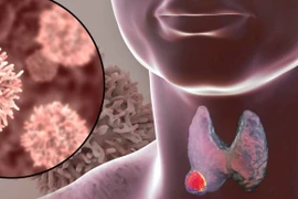 Chế độ ăn ăn kiêng cho bệnh nhân uống I - ốt phóng xạ