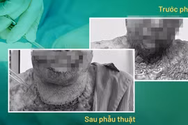 Vừa đốt cỏ làm rẫy vừa hút thuốc lá nam thanh niên bỏng 75% cơ thể