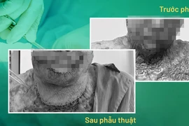 Vừa đốt cỏ làm rẫy vừa hút thuốc lá nam thanh niên bỏng 75% cơ thể