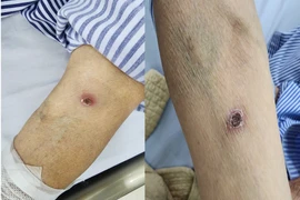 Người bệnh đái tháo đường bị sốt mò biến chứng nguy hiểm