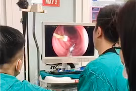 Nội soi lấy kim diệt tủy răng rơi vào tá tràng bé trai 8 tuổi