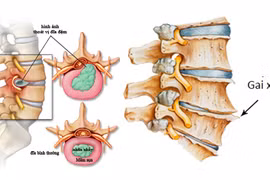 Có nên cắt bỏ gai cột sống?