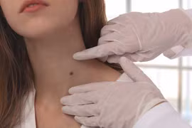 Dấu hiệu cảnh báo u vùng cổ ác tính