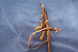 Lấy cành cây khô 10cm trong bàng quang bệnh nhân