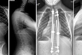 Vẹo cột sống khởi phát sớm có thể gây tử vong: Phát hiện cách nào?