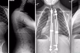 Vẹo cột sống khởi phát sớm có thể gây tử vong: Phát hiện cách nào?
