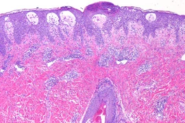 Phát ban mụn mủ toàn thân cấp tính do dùng thuốc