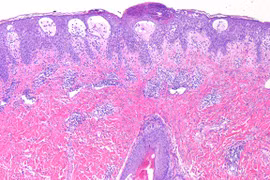 Phát ban mụn mủ toàn thân cấp tính do dùng thuốc