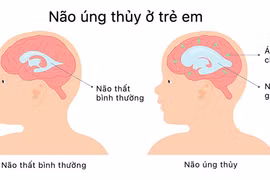 Hầu hết các trường hợp não úng thủy có thể điều trị?