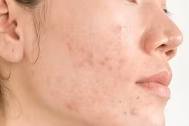 Sạm da, nổi mụn vì dùng Retinoids sai cách