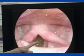 Khàn tiếng, vướng cổ không ngờ đỉa dài 6 cm sống trong cổ họng 1 tháng