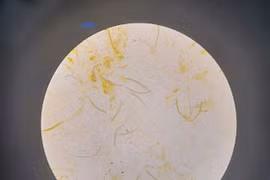 Giun lươn: bệnh truyền nhiễm nguy hiểm nhiều người mắc nhưng bị lãng quên