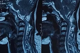 Bệnh nhân ung thư phổi di căn đốt sống cổ cao 