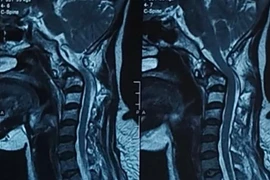 Bệnh nhân ung thư phổi di căn đốt sống cổ cao 