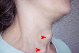 Một phát hiện hiếm về ung thư biểu mô tuyến giáp không biệt hóa: áp xe 