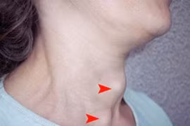 Phát hiện ung thư tuyến giáp từ một dấu hiệu lạ khi uống nước
