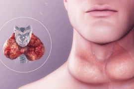 Ung thư tuyến giáp tái phát ở đâu?