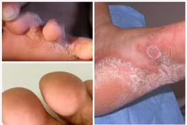 Chăm sóc, phòng tránh bệnh da và nguy cơ bỏng đúng cách mùa bão lũ