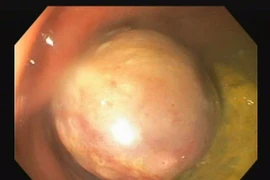 Hy hữu: Bé 37 tháng tuổi có polyp lớn trực tràng sa ra ngoài, chảy máu