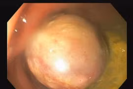 Hy hữu: Bé 37 tháng tuổi có polyp lớn trực tràng sa ra ngoài, chảy máu