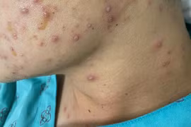 Nhiều bệnh nhân thủy đậu kiêng tắm bị biến chứng nguy hiểm tính mạng