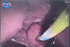 Cứu bệnh nhân u lớn đầu tụy làm biến dạng tá tràng